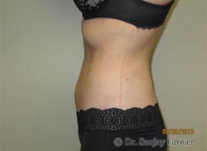 Liposuction Before and After 54 | Sanjay Grover MD FACS