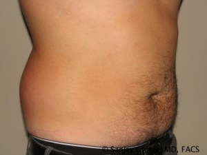Liposuction Before and After 01 | Sanjay Grover MD FACS