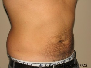 Liposuction Before and After | Grover Aesthetics