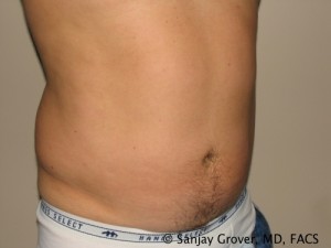 Liposuction Before and After 42 | Sanjay Grover MD FACS