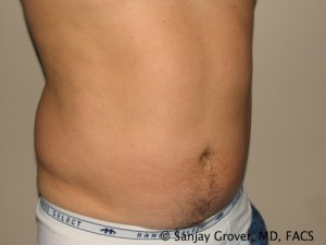 Liposuction Before and After 41 | Sanjay Grover MD FACS