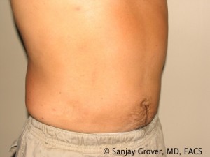 Liposuction Before and After | Sanjay Grover MD FACS