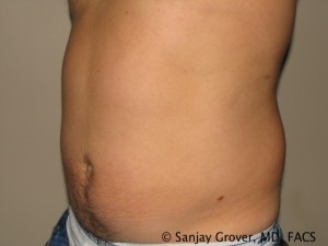 Liposuction Before and After 56 | Grover Aesthetics