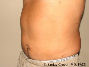 Liposuction Before and After 56 | Sanjay Grover MD FACS