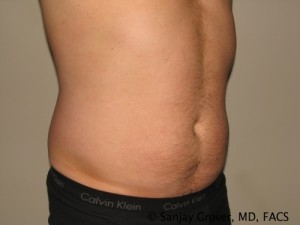 Liposuction Before and After 23 | Sanjay Grover MD FACS