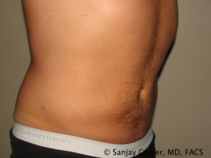 Liposuction Before and After 57 | Sanjay Grover MD FACS