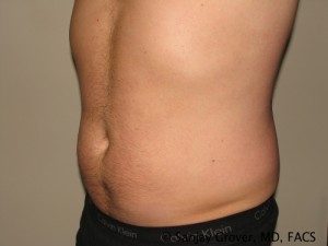 Liposuction Before and After 57 | Grover Aesthetics