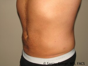 Liposuction Before and After 57 | Grover Aesthetics