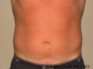 Liposuction Before and After 15 | Sanjay Grover MD FACS