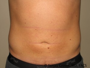 Liposuction Before and After | Grover Aesthetics