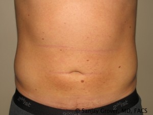 Liposuction Before and After 58 | Sanjay Grover MD FACS