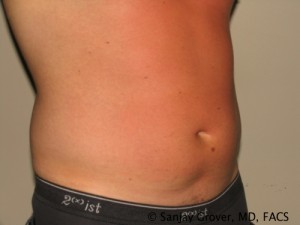 Liposuction Before and After 58 | Grover Aesthetics
