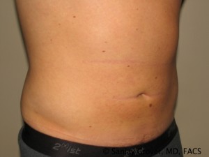 Liposuction Before and After 58 | Sanjay Grover MD FACS