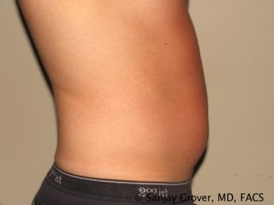 Liposuction Before and After 58 | Grover Aesthetics