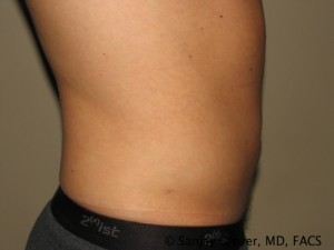 Liposuction Before and After 58 | Grover Aesthetics
