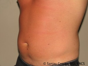 Liposuction Before and After 58 | Grover Aesthetics