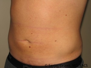 Liposuction Before and After 58 | Grover Aesthetics