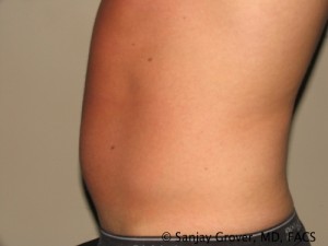 Liposuction Before and After 58 | Grover Aesthetics