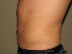 Liposuction Before and After 58 | Grover Aesthetics