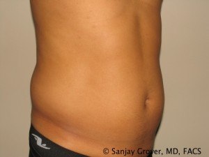 Liposuction Before and After | Grover Aesthetics