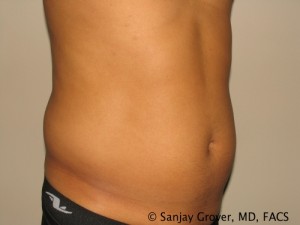 Liposuction Before and After 01 | Sanjay Grover MD FACS