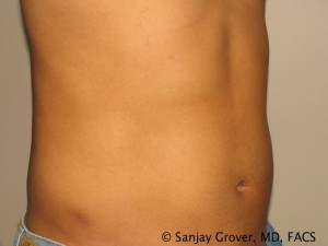 Liposuction Before and After | Sanjay Grover MD FACS