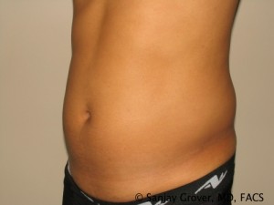 Liposuction Before and After 59 | Grover Aesthetics