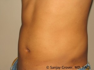Liposuction Before and After 59 | Grover Aesthetics