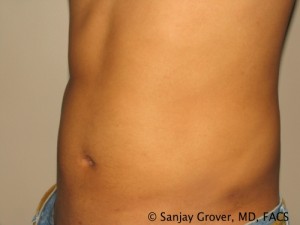 Liposuction Before and After 59 | Sanjay Grover MD FACS