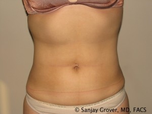 Liposuction Before and After 50 | Sanjay Grover MD FACS