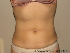 Liposuction Before and After 18 | Sanjay Grover MD FACS