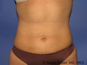 Liposuction Before and After | Grover Aesthetics