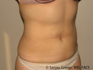 Liposuction Before and After 60 | Grover Aesthetics