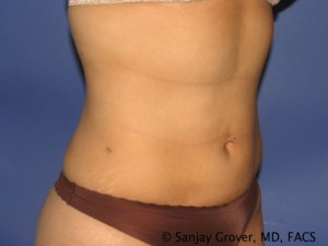 Liposuction Before and After 60 | Sanjay Grover MD FACS