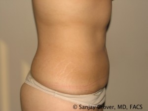 Liposuction Before and After 60 | Grover Aesthetics