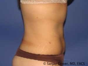 Liposuction Before and After 60 | Grover Aesthetics