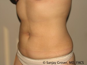 Liposuction Before and After 60 | Grover Aesthetics