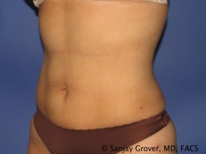 Liposuction Before and After 60 | Grover Aesthetics