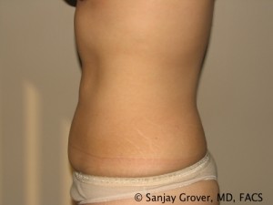 Liposuction Before and After 60 | Grover Aesthetics