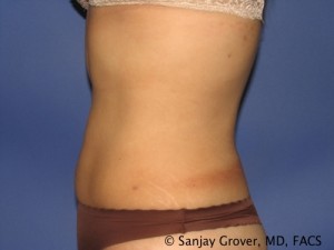 Liposuction Before and After 60 | Grover Aesthetics