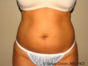Liposuction Before and After 08 | Sanjay Grover MD FACS