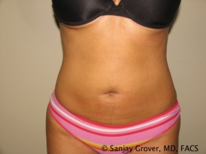 Liposuction Before and After 61 | Sanjay Grover MD FACS