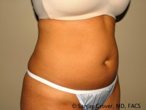 Liposuction Before and After 61 | Grover Aesthetics