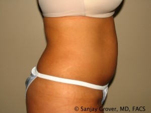 Liposuction Before and After 61 | Sanjay Grover MD FACS