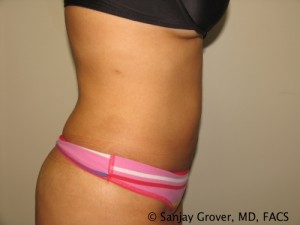 Liposuction Before and After 61 | Grover Aesthetics