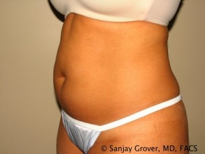 Liposuction Before and After 61 | Grover Aesthetics