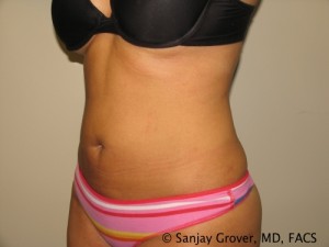 Liposuction Before and After 61 | Sanjay Grover MD FACS