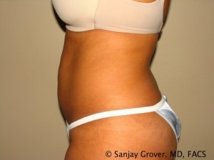 Liposuction Before and After 61 | Grover Aesthetics