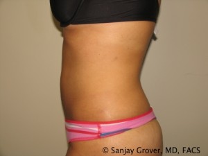 Liposuction Before and After 61 | Grover Aesthetics