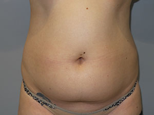 Liposuction Before and After 53 | Sanjay Grover MD FACS